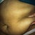 pre op side view yuk!
