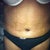 10 day post op