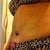4wk post op side view