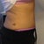 3.5 weeks post-op