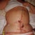 A few days post op