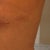 Left side-boob so you can see where incision ends and channel bruising from Lipo begins.