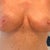 Close-up so you can see boxiness is sllooooowwwwwwwwly getting a little better on righty and lefty is still noticeably more swollen but developing a similar droop on outside lower quadrant.  Expect that is a result of swelling moving on.  Not noticeable in bra, so, meh...