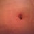 PO day 16. Close up of bb. Much smaller than I anticipated. Still has crusties so not sure what it will like in the end.