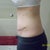 Day 18 Post Op