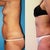 3 months post surgery