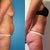 3 months post surgery