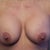 11 weeks one day post op