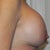 11 weeks one day post op 3