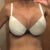 3 weeks post op