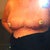 1 day post op. free nipple graft coverings sewn on.