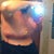 1 day post op side view.