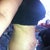 3 weeks post op