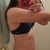 1 week post op