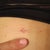 Tiny incision - look how well it has healed already! That's my pinky finger... ignore the chipped polish. I haven't changed it since before the operation!