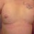 day two post op