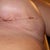 2 wk post op - scars are fading