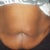 Before my surgery