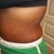 1 month after surgery