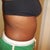 1 month after surgery