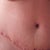 Close up on incision.  Still hunched over so my torso looks pretty short.