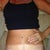 Scar at 6 months post op