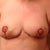 day 3 post op