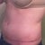 WK 12 AM no overnight compression The roundness you see is my hip