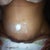 incision on Tuesday 7/10