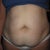 October 2nd "Before" pic of just belly.  Grossness!