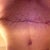 Scar at 4 weeks PO