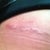 Incision day 8