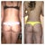 Petite 5'1 120lbs Liposuction of Abdomen, Flanks, Inner & Outer Thighs - 
4 days post op. Before and after.