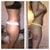 Petite 5'1 120lbs Liposuction of Abdomen, Flanks, Inner & Outer Thighs - 
4 days post op. Before and after.