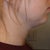 3 Weeks Post - Right Side