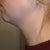 3 Weeks Post - Left Side