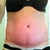 Front at 12 weeks PO