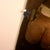 POST OP .. lipo of arms, flanks, abdomen, thighs, and knees.  only 350 ccs though