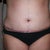 Front - 1 day post-op