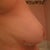 8 days post-op Left Breast