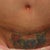 2 week's post-op
