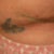 2 week's post-op