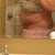 2 week's post-op