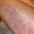 Day after surgery bruising