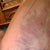 Day after surgery bruising