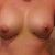 One Week post-op