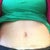 Pod 16 My belly button going in little by little thanks to the dressing.