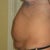 before MTT