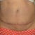 10 days after MTT