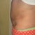 10 days after MTT